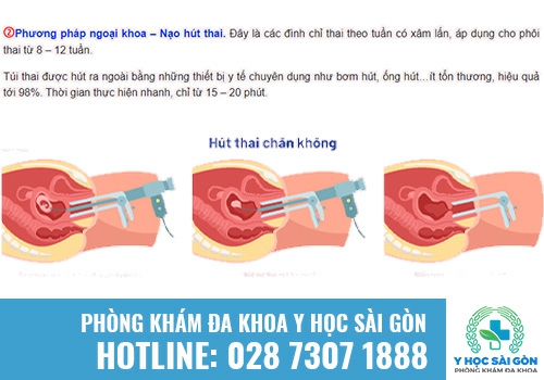 Nạo thai có ưu nhược điểm gì?